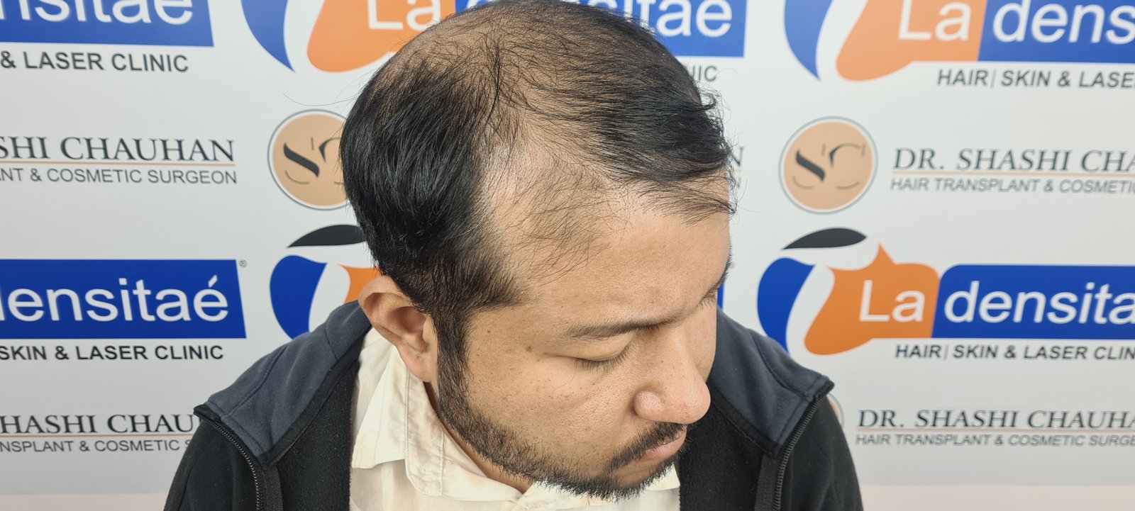 Dr. Bishal Before Hair Transplant